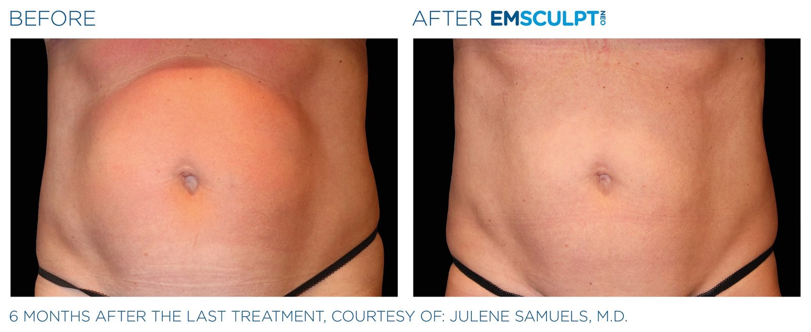 Emsculpt Neo before and after — abdominal contour