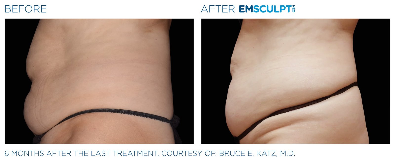 Emsculpt Neo before and after — core strength