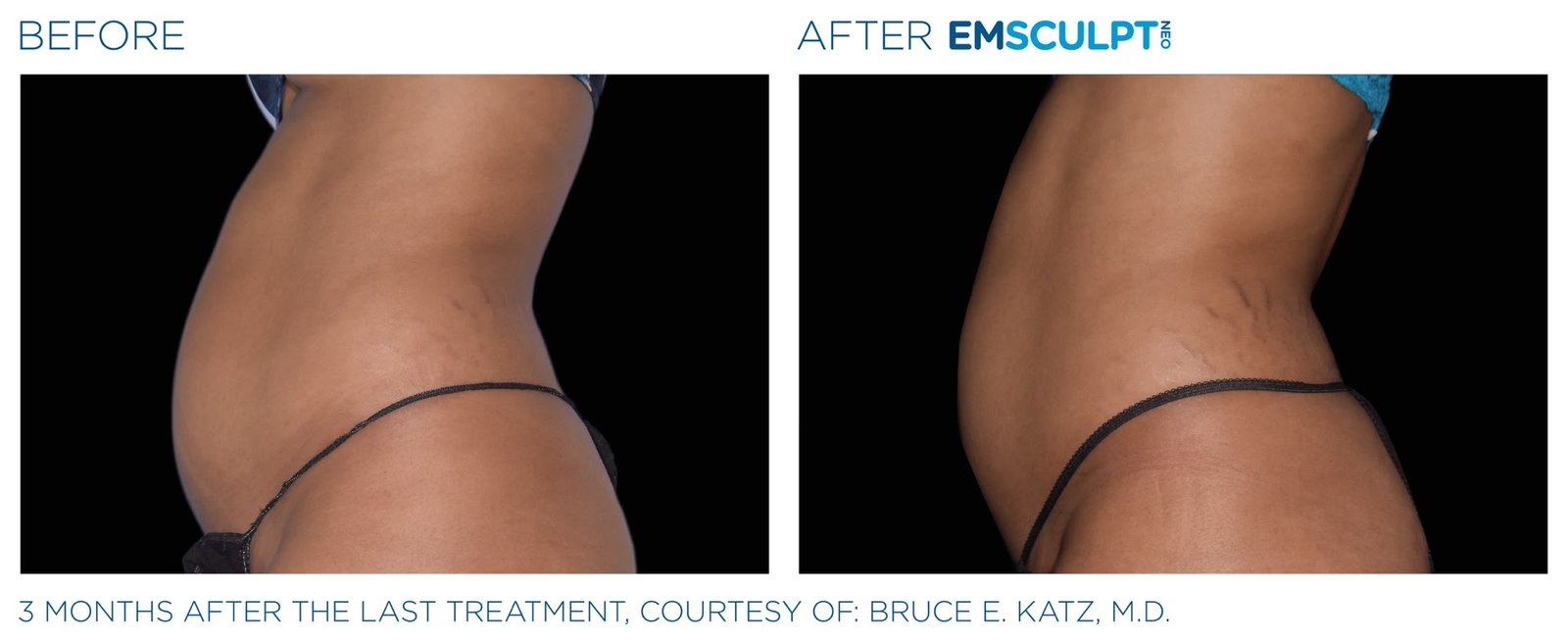 Emsculpt Neo before and after — waist and flank