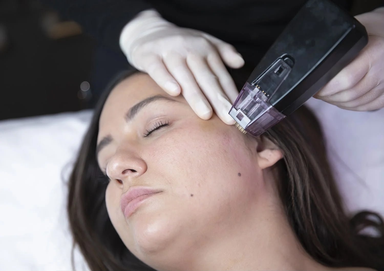 Morpheus8 skin tightening treatment